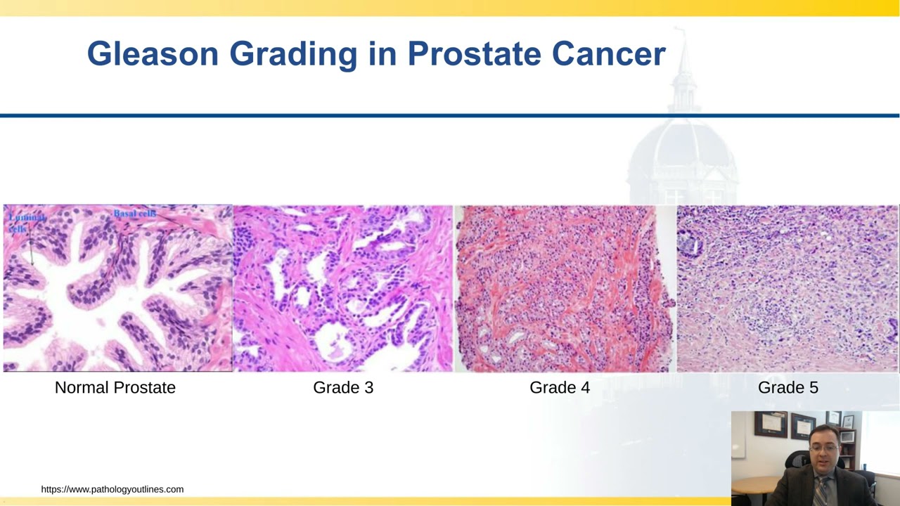 Monitoring Tumor Microenvironment Immunotherapeutic Impact in Heterogeneous Cancer: Prostate Cancer,