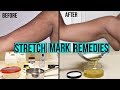 HOW TO GET RID OF STRETCH MARKS & SCARS + DIY AT HOME ...