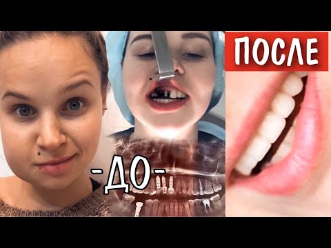 Моя страшная история зубов /Импланты, Коронки, Виниры