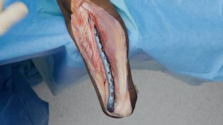 Distal Humerus Shaft Fracture Fixation Using the Arthrex Elbow Plating System
