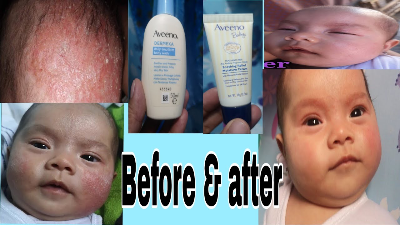 how-to-remove-rashes-and-cradle-cap-howtoremoverashes-youtube