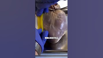 3Dプリントで作る心臓バンド