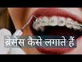 30 min  ब्रेसेस कैसे लगाते हैं, How To put on Dental Braces Step by Step process in Delhi