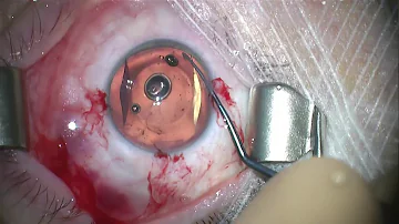 Quelle est l'utilité de l'implant oculaire ?