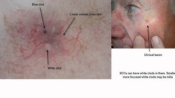 Dermoscopy Made Simple - BCC