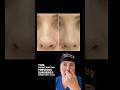 Complex revision rhinoplasty:  extreme nostril asymmetry.