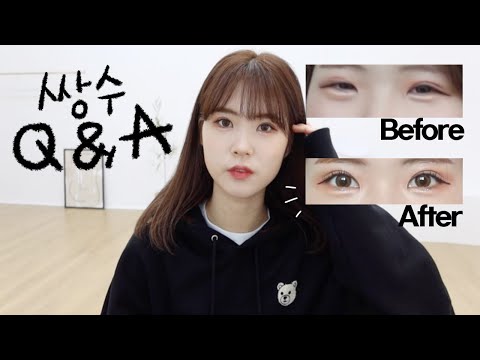 [유경몬] 한층 커진 눈으로 돌아온 TMI 대방출 <strong>쌍수</strong> 눈매교정 앞트임 <strong>후기</strong>