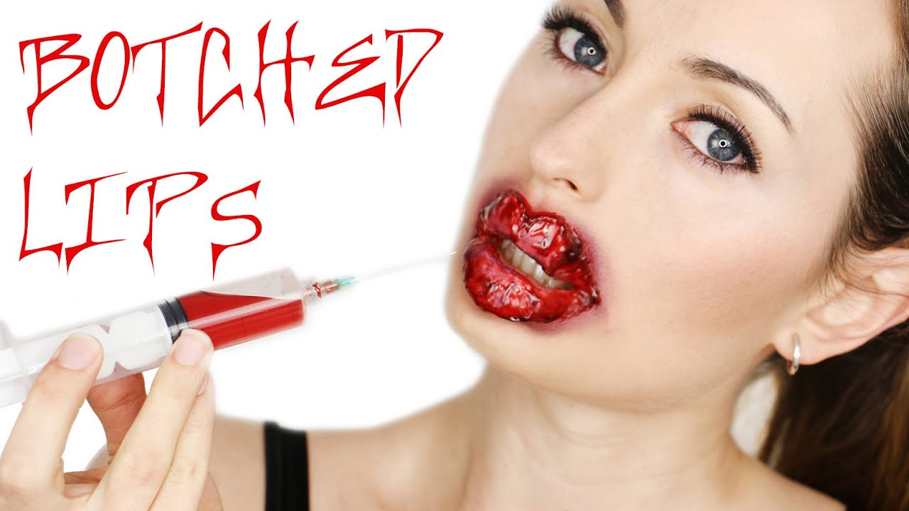 Botched! Lip injections gone wrong! - YouTube