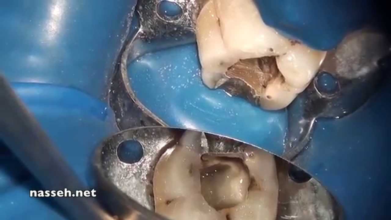 EndoSequence BC Sealer Healing YouTube
