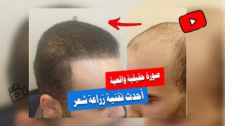 احدث طرق زراعة الشعر في مصر | الطريقة الاقرب لشكل الشعر الطبيعي
