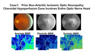 Reduced Blood Flow And Pulsatility In The Choroidal Watershed And Peripapillary Hypoperfusion Zones