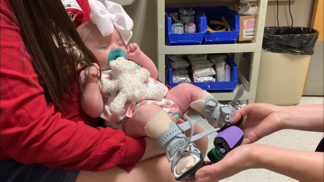 Cast Removal & Boots and Bar Fitting - Clubfoot Journey