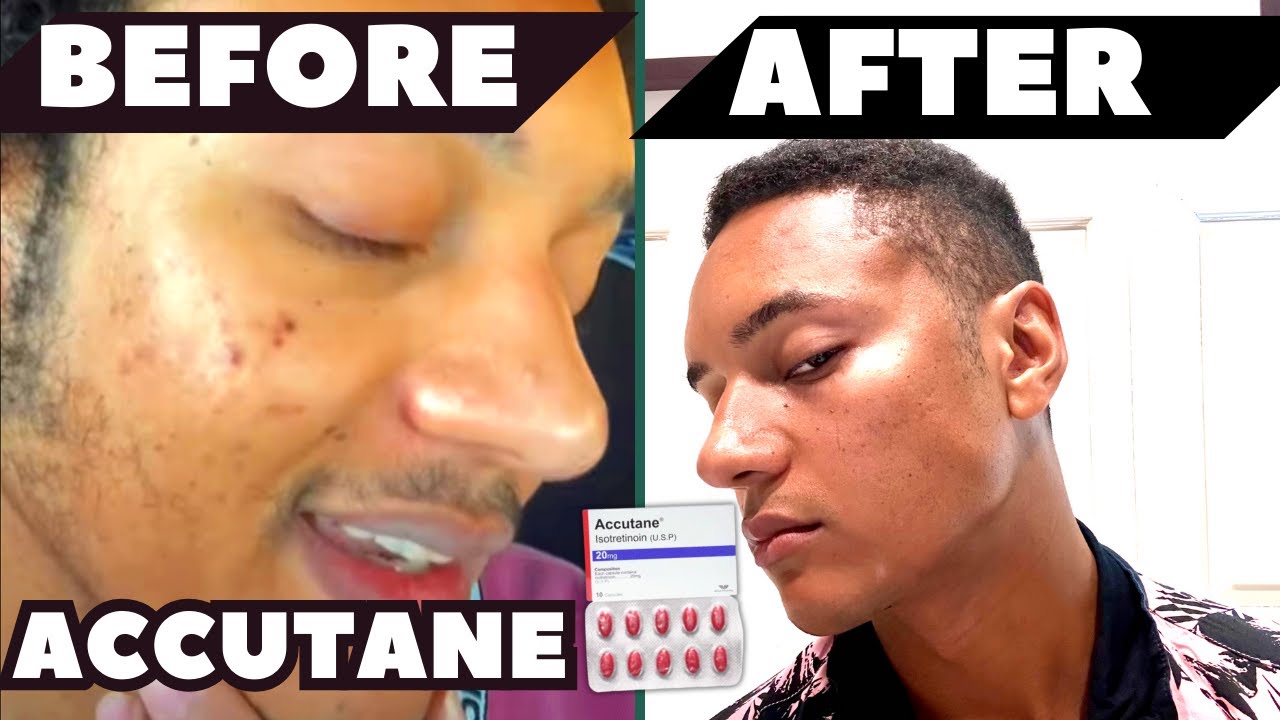 3 Months After Accutane Considering Laser Treatment for Acne Scars