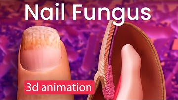 Nail Fungus: Understanding the Infection and Nail Growth 3d Animation