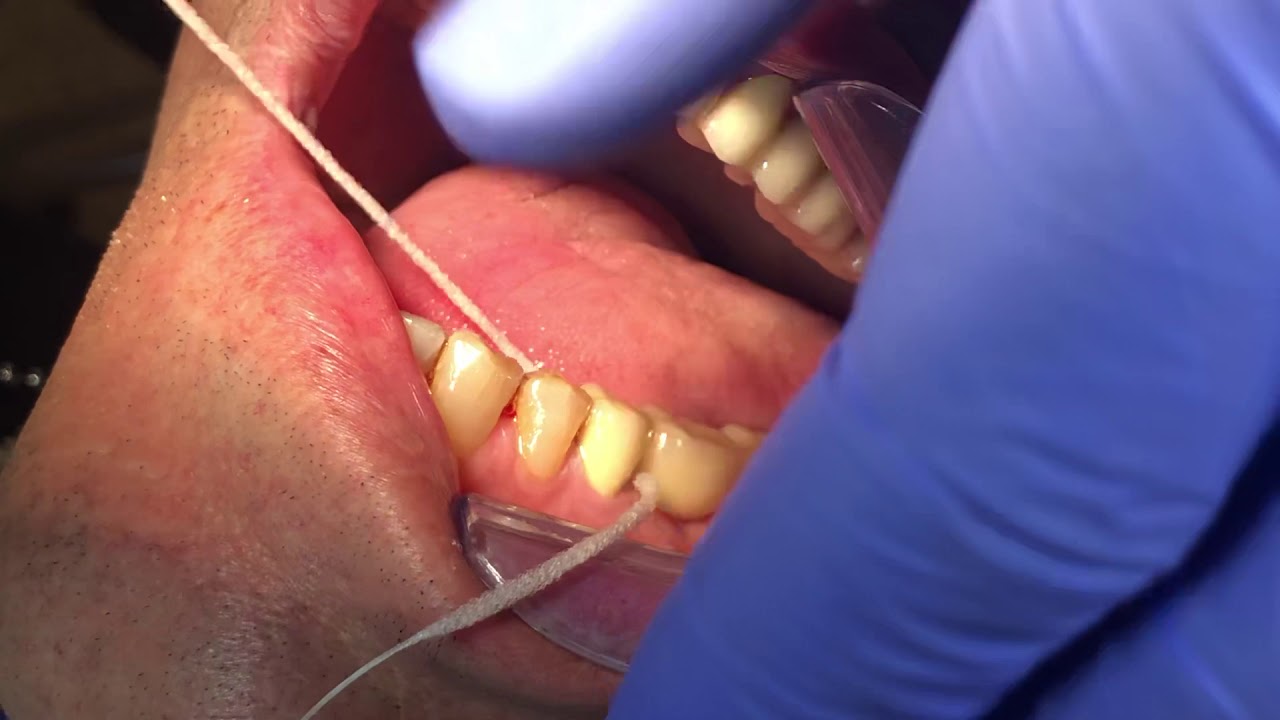 Cleaning of pontics YouTube