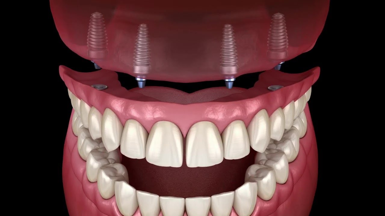 Allon4 Dental Implants Glendale & Phoenix AZ Arizona Center For