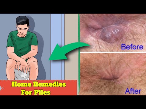 Home Remedies For Piles/Haemorrhoids | Natural Treatments