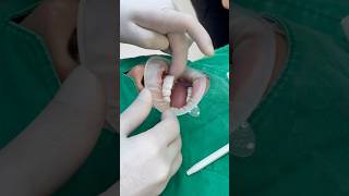 👍당일완성 🌸라미네이트 👉치료과정 #laminate #veneers #procedure #cerec #mcx #mcxl #milling