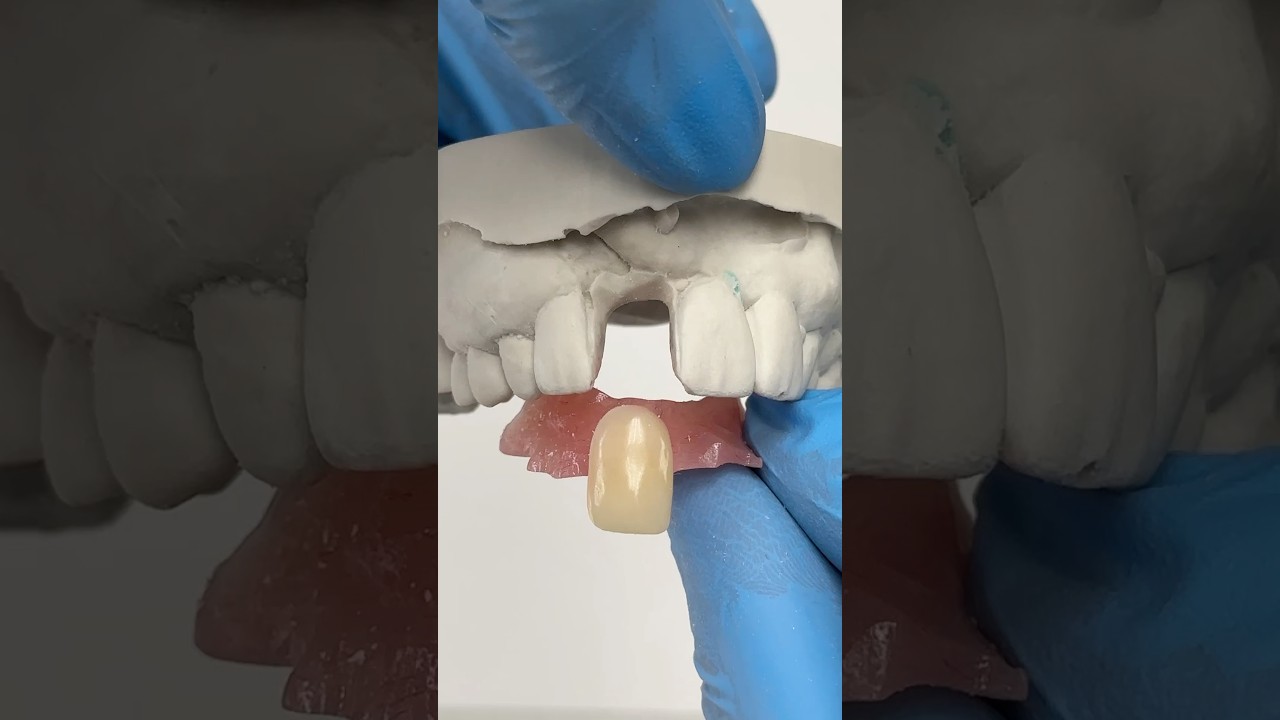 Gigi Tiruan Sebagian ActyGrip Flipper #lsk121shorts #doktergigi #gigi