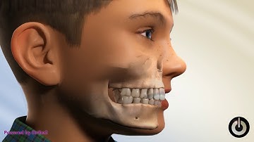 Class II Malocclusion