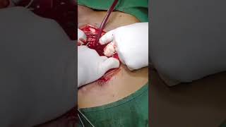 #Hemoperitoneum secondary to Blunt Trauma Abdomen managed successfully.
