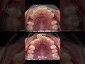 Braces proces  tooth extraction fix overbite teeth