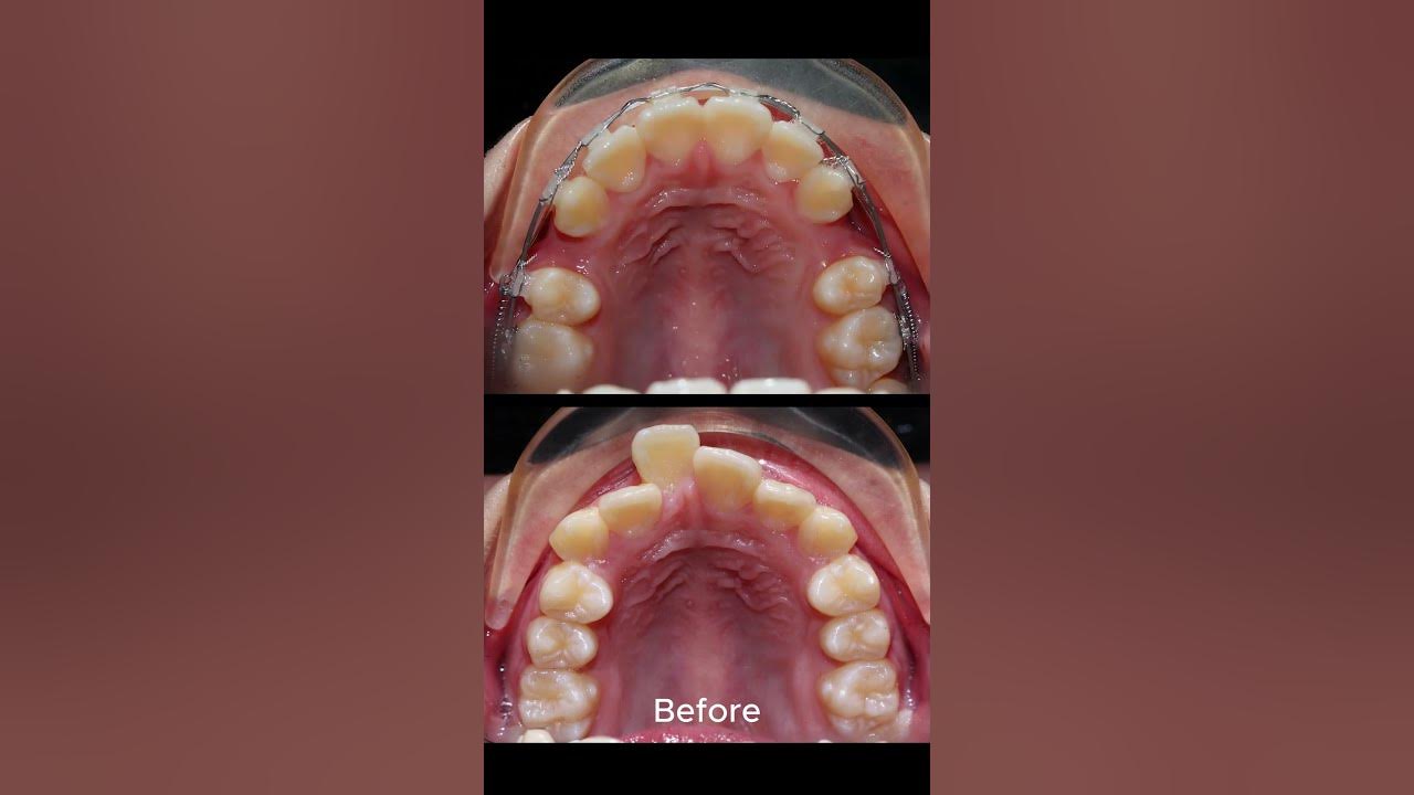 Braces proces tooth extraction fix overbite teeth YouTube
