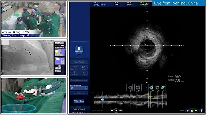 IVUS-Guided PCI and Single Stent of LM Bifurcation Lesion