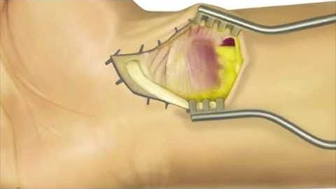 VOLAR SCAPHOID APPROACH