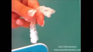 5  Filing Invisalign Tray