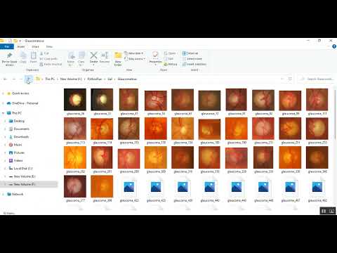 Performance Analysis of Glaucoma Detection Using Deep Learning Models