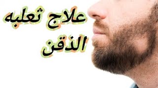 علاج ثعلبه الذقن