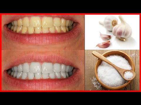 Vídeo: Blanqueamiento Dental En Casa: 5 Formas Efectivas