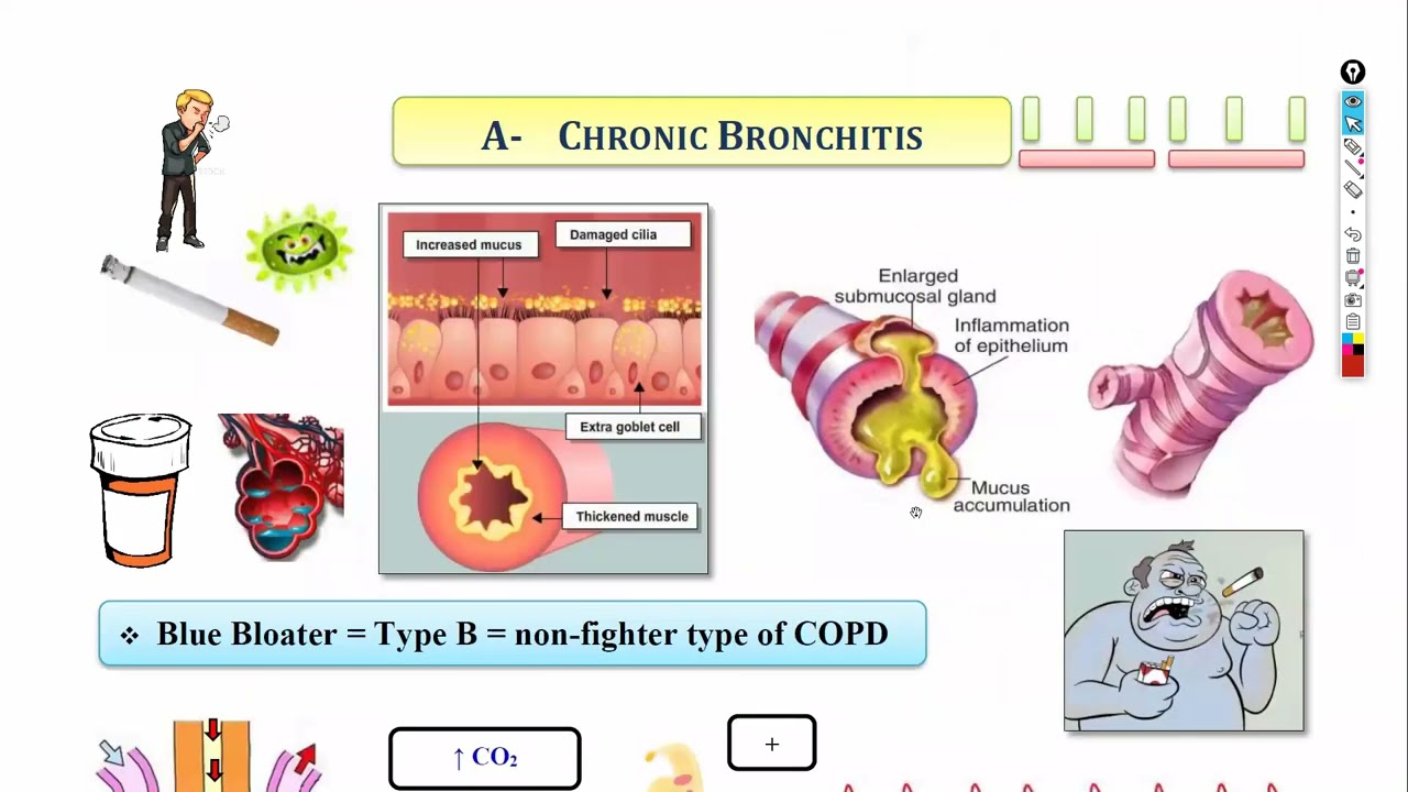 4-COPD, Pulmonary hypertension & Cor pulmonale شرح باطنة دكتور سويلم