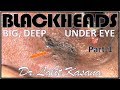 UNDER EYE DEEP BLACKHEADS PART -1 BY DR.LALIT KASANA