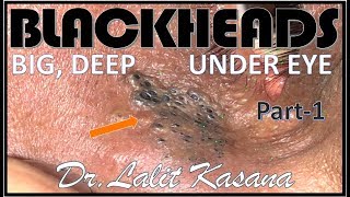 UNDER EYE DEEP BLACKHEADS PART -1 BY DR.LALIT KASANA