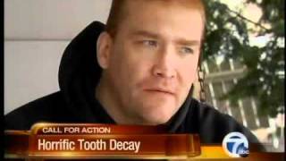 Horrific tooth decay