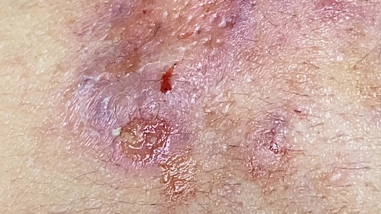Acne, Pustules - SacdepSpa#57
