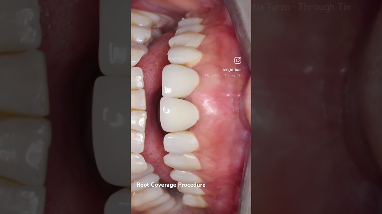 Multiple Gingival Recession. Root coverage treatment by tunneling technique. 