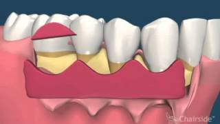 лечение пародонтита в волгограде(, 2013-05-24T20:41:12.000Z)