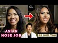 Asian Rhinoplasty | Asian Nose Job | Pretty to Prettier® - Beverly Hills