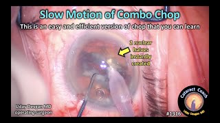 CataractCoach 1316: slow motion combo phaco chop technique