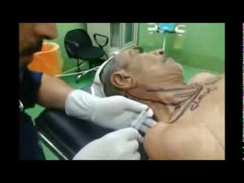 superficial cervical plexus block&suprascapular nerve block