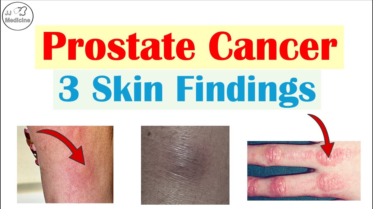 Эти три странных симптома кожи могут указывать на рак простаты