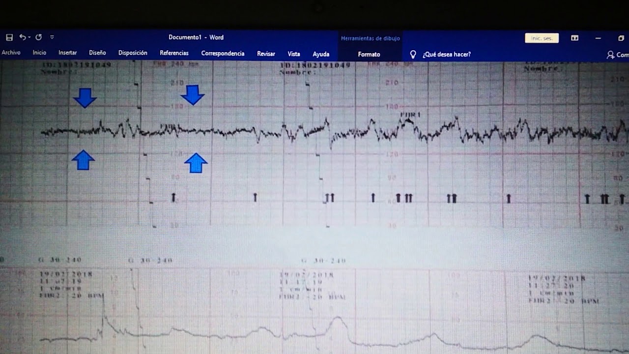 Interpretación de trazo de la frecuencia cardiaca fetal