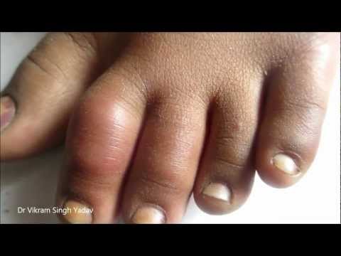 Frost Bite Treatment