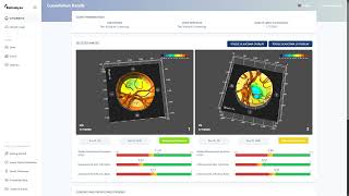 The RetinaLyze Glaucoma 3D overlay is launching at opti 2026 this week! 👀