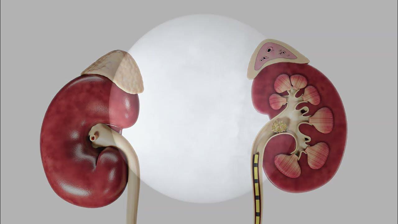 UltraMini PCNL Procedure Overview For A Patient YouTube