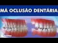 Má oclusão dentária - Classificação das maloclusões ©