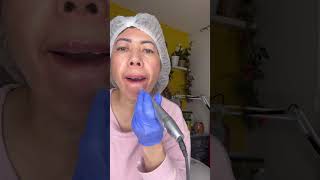 "Vampire Lips Rejuvenation" Contact me... text only 780-885-8349 #lipfiller#health#follower#everyone